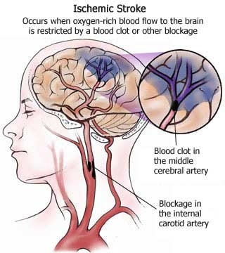 Infarctul cerebral